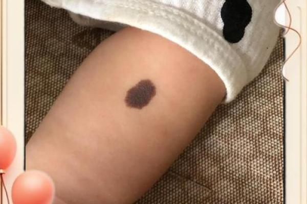 面部上的胎记算命分析