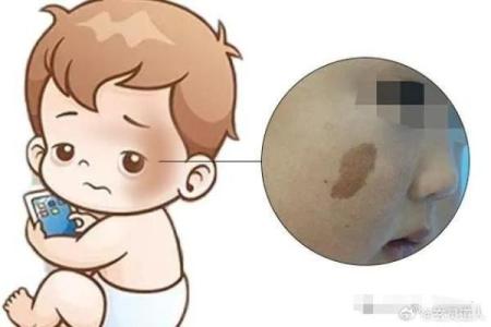 面部上的胎记算命分析