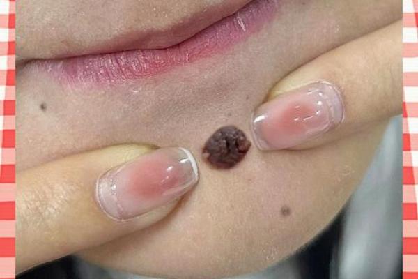 女人有黑观音痣 下巴的痣房屋多