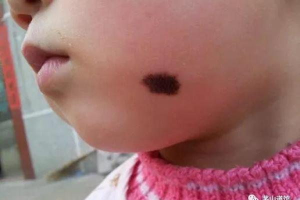 眼睛上的胎记算命分析