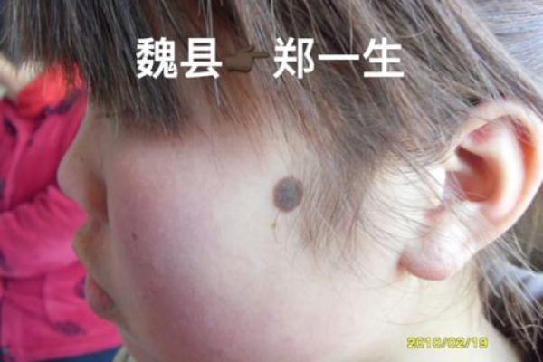 算命黑色胎记